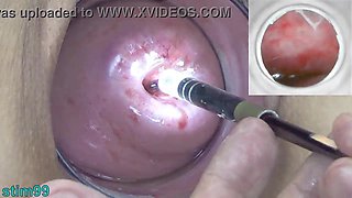 Watch inside the uterus of Asian woman with Endoscope camera into Cervix