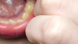 I Tell You About the Fillings in My Teeth and Dental Visits
